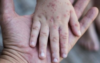 Вірус Коксакі в Україні: небезпека і симптоми