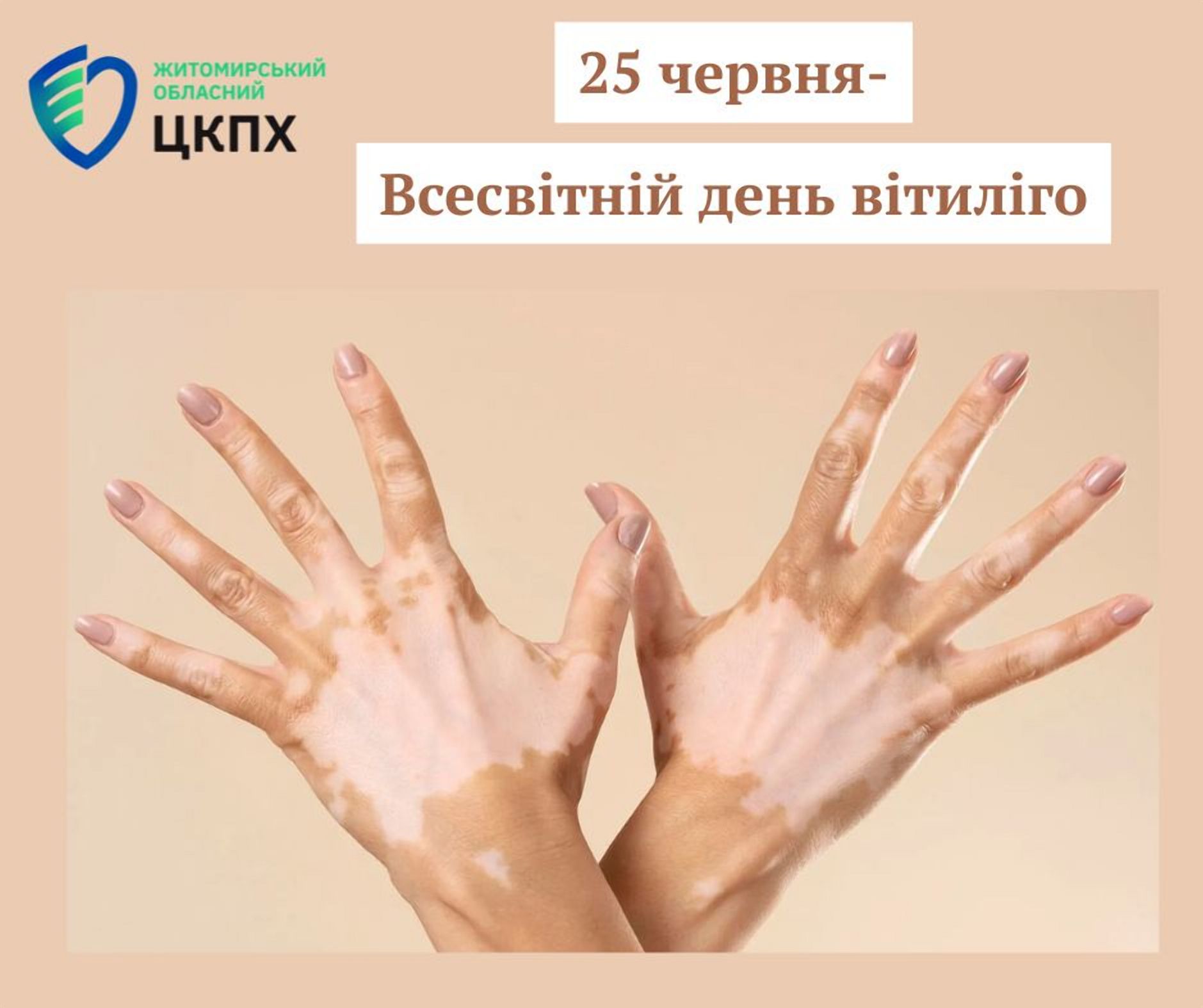 25 червня: Світ відзначає День вітиліго, присвячений обізнаності та підтримці